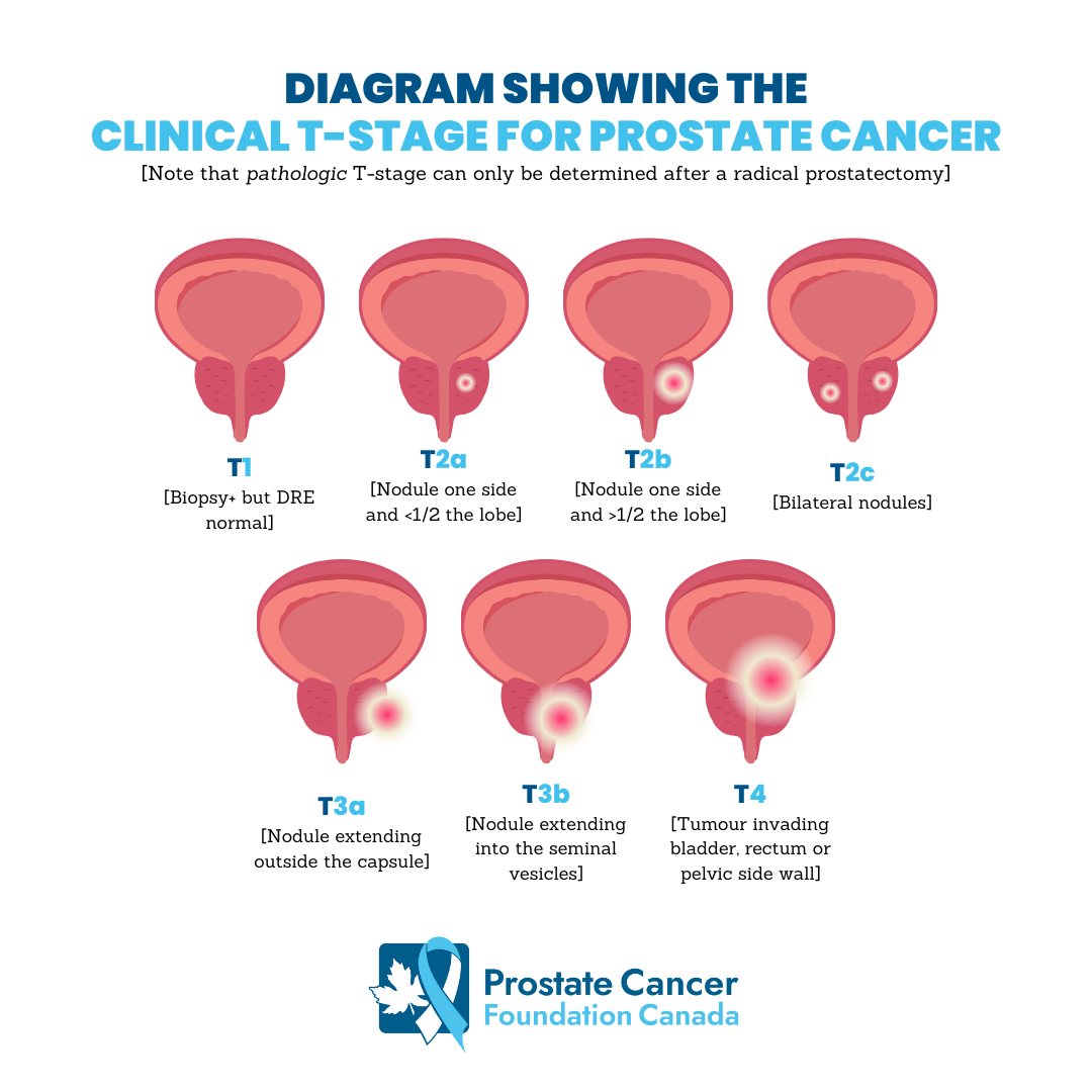 Prostate Cancer Foundation Canada